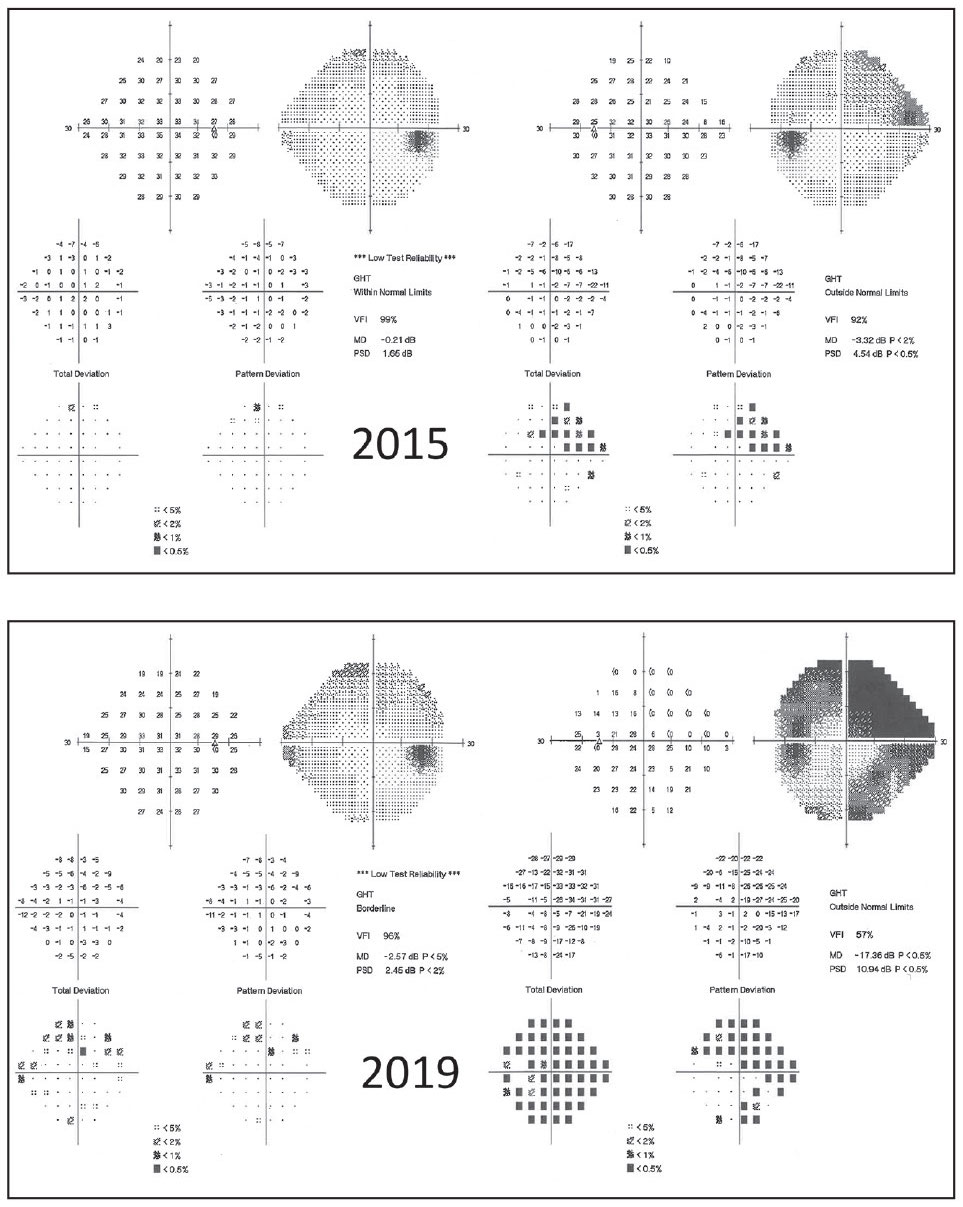 TMTD analysis incorporates similarities from other trend analyses of pointwise linear regression and cluster trend analysis by clustering the VF into hemifields and estimating regional VF rate of change after excluding scotoma locations. 