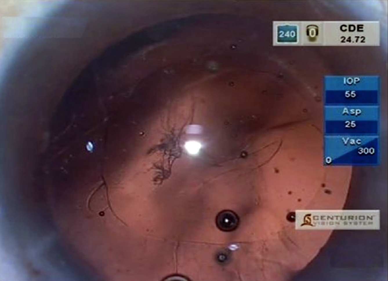 Intraoperative complication rates were similar between nAMD eyes and control eyes, but extra care should be taken with these eyes if they’ve had several prior intravitreal injections.