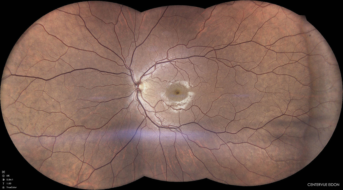 Fig. 3. Assess the retina with a dilated fundus examination for any current myopic changes and set a baseline for future comparisons.