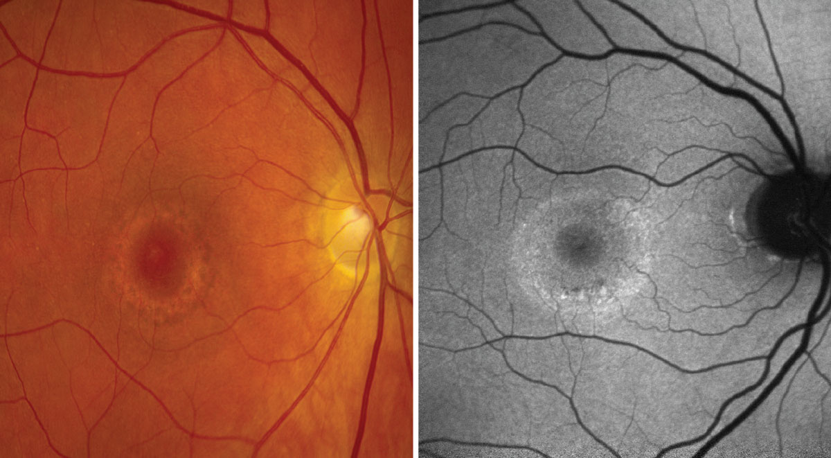 Reveal Hidden Retinal Disease Using FAF Imaging