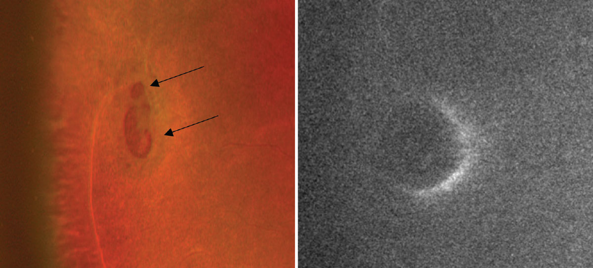 The color photo on the left captures two atrophic holes that are suspected to have a cuff of fluid due to the elevated edges (black arrows). On the right, the FAF photo reveals a crescent-shaped area of hyperfluorescence anterior to the atrophic holes and confirms the presence of a cuff of edema.