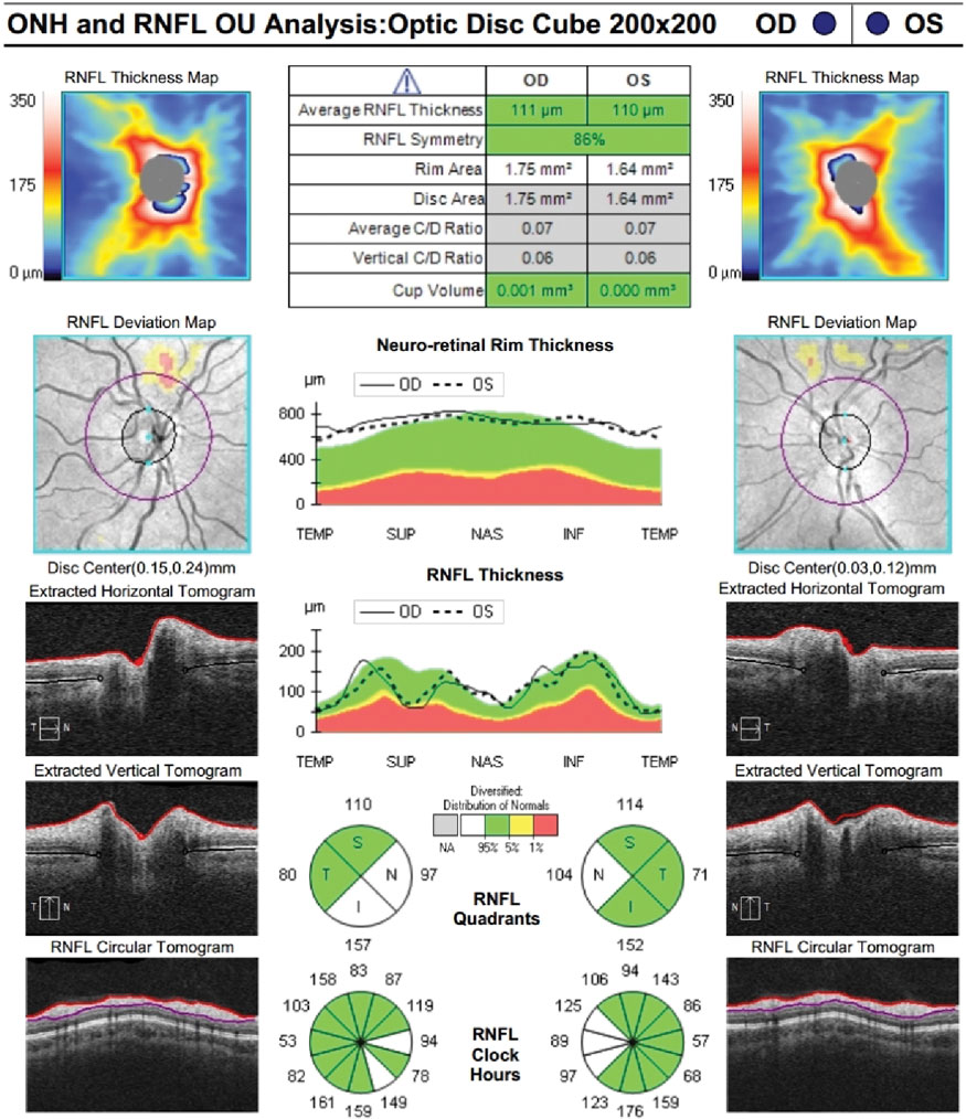 Zeiss Cirrus RNFL OU at follow-up.