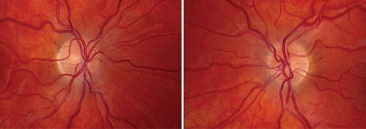 Topcon fundus photo of optic nerve OD at presentation (left). Topcon fundus photo of optic nerve OS at presentation (right).