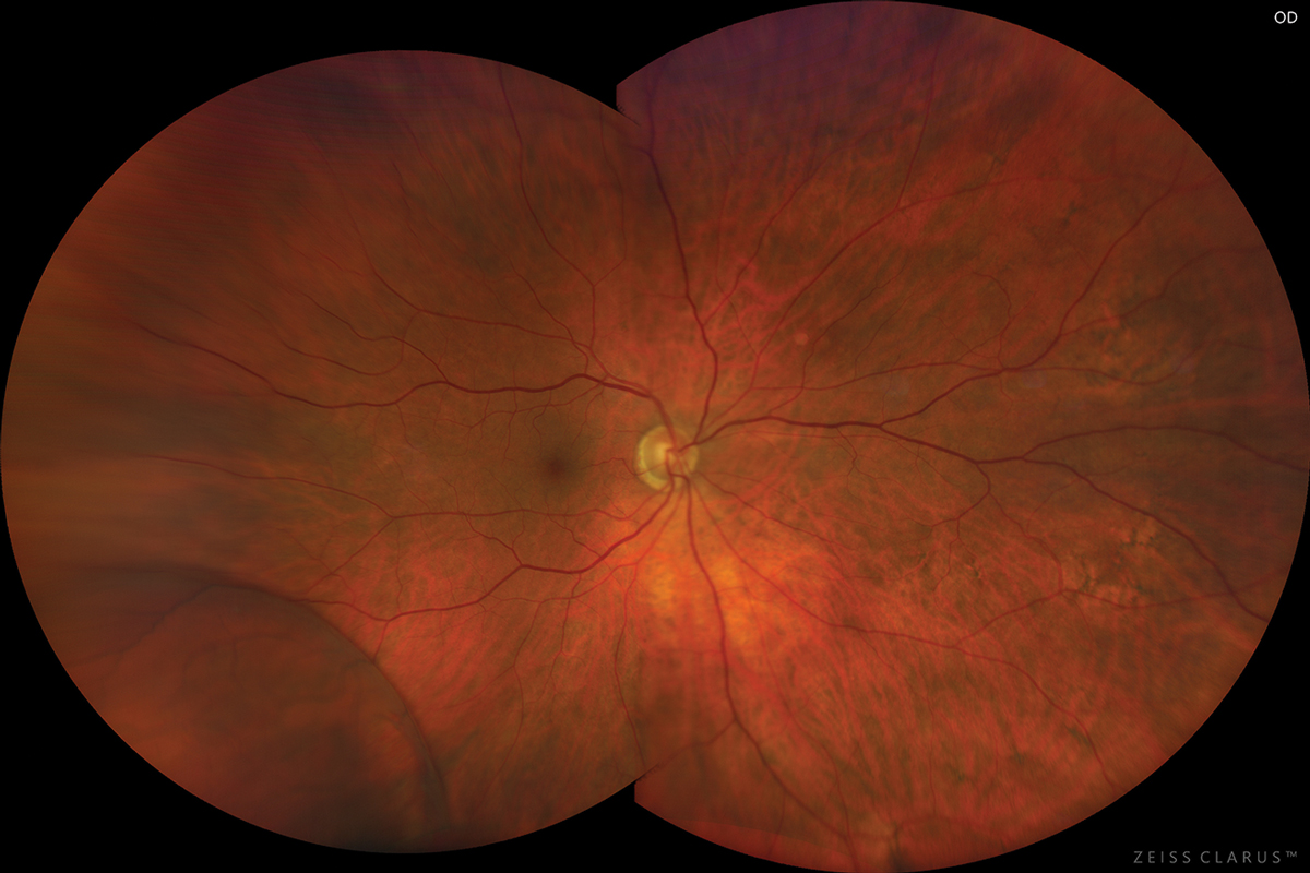 This photo of a different patient with the same condition shows a comparable presentation.