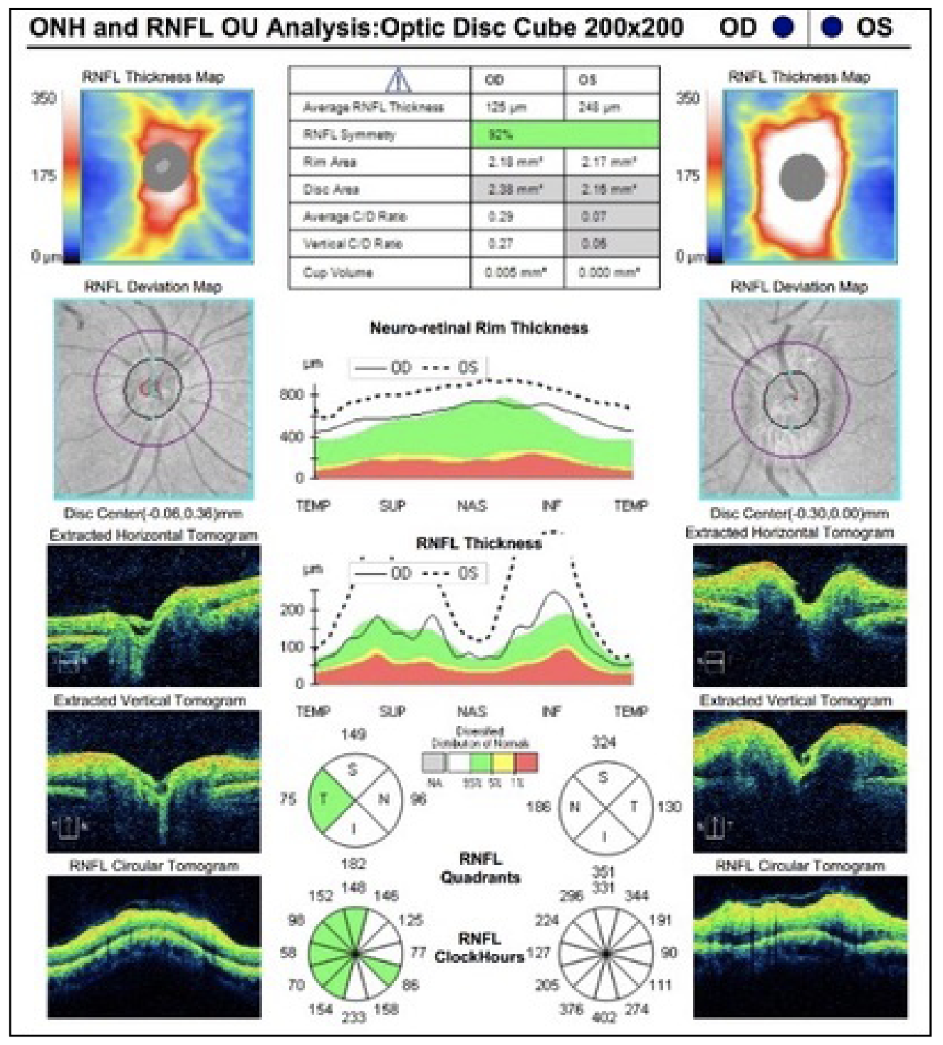 Fig. 2. OCT of the RNFL of both eyes. The right eye is unremarkable and the left eye presents with 360 degrees of RNFL thickening.