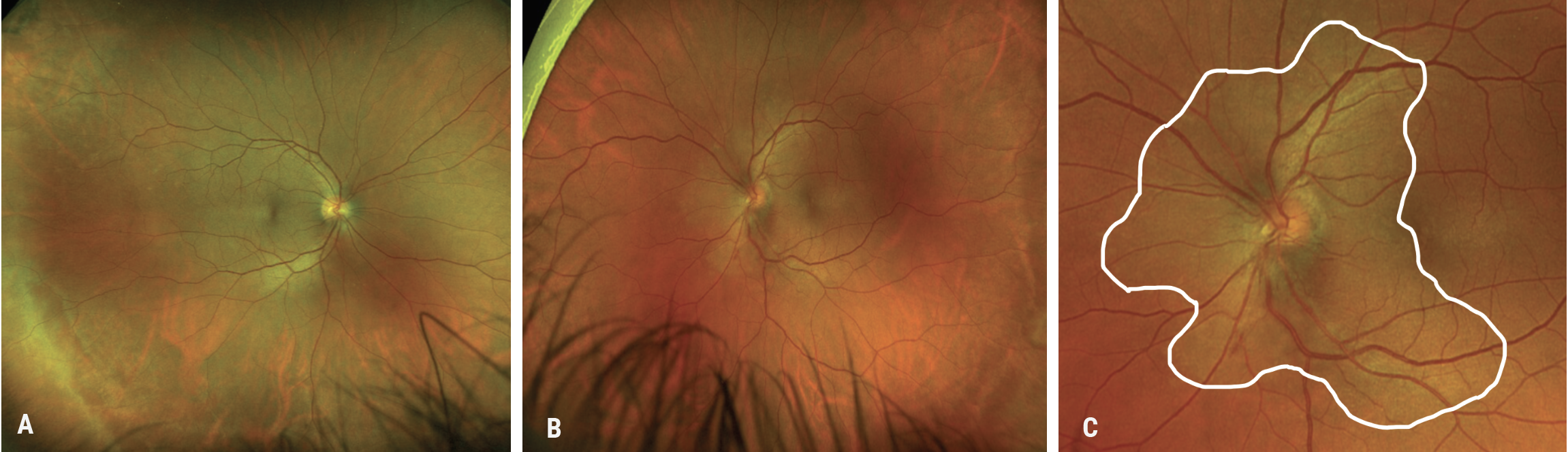 Fig. 3. (A) Fundus photo of the right eye with mild peripheral pigmentary changes, but otherwise unremarkable. (B) Fundus photo of the left eye demonstrates a large, faintly yellowish placoid lesion circumventing the optic nerve, along with blurred optic disc margins and a small inferior hemorrhage. (C) Enlarged fundus photo of the left eye allows for better visualization of the yellowish placoid lesion circumventing the optic nerve (outlined in white) along with blurred optic disc margins and a small inferior hemorrhage. 