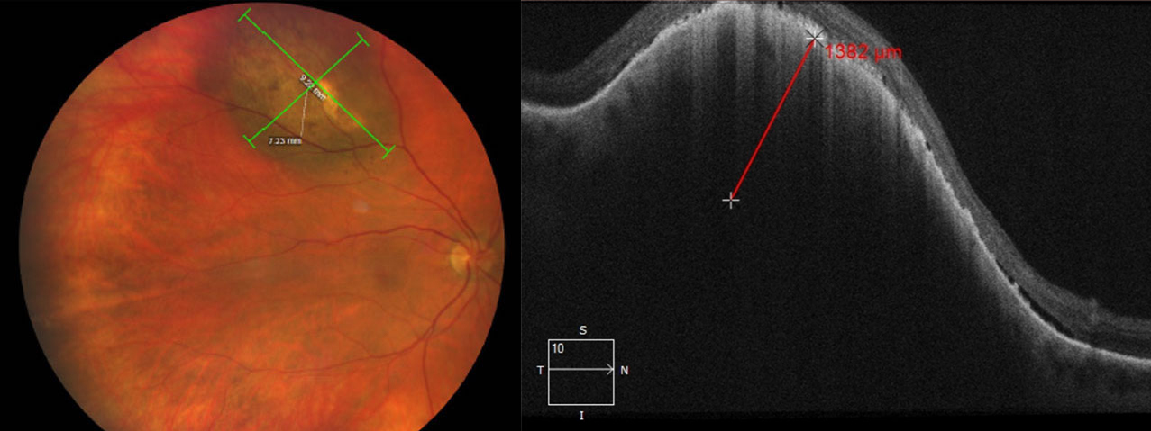 Fitzpatrick Skin Type doesn’t predict melanoma outcomes across the board. For example, cutaneous melanoma outcomes vary with skin type while conjunctival melanoma outcomes don’t. 