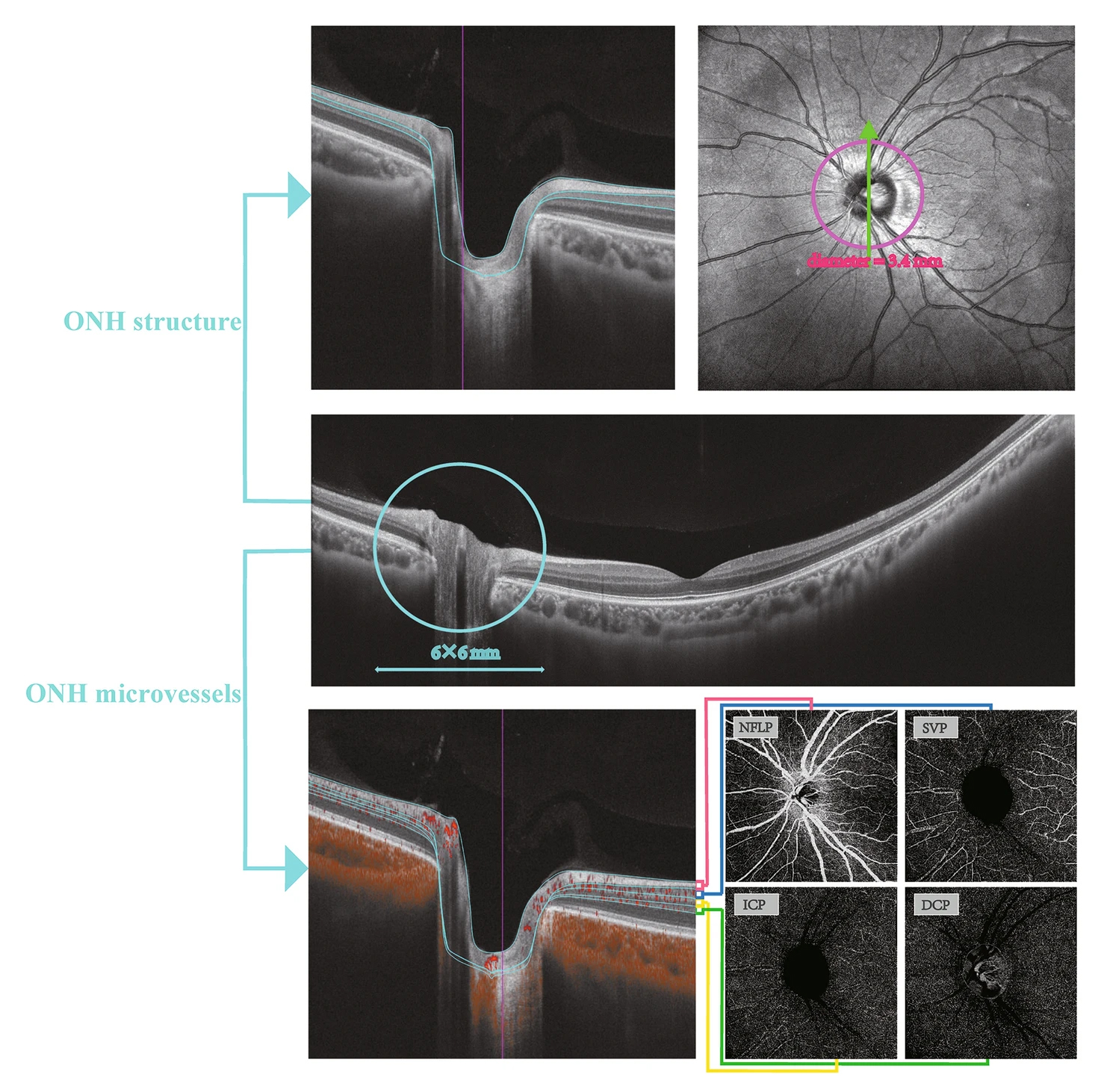 Objective clinical tools such as OCT and OCT-A can offer reliable data on visual acuity changes, such as macular structural measurements.