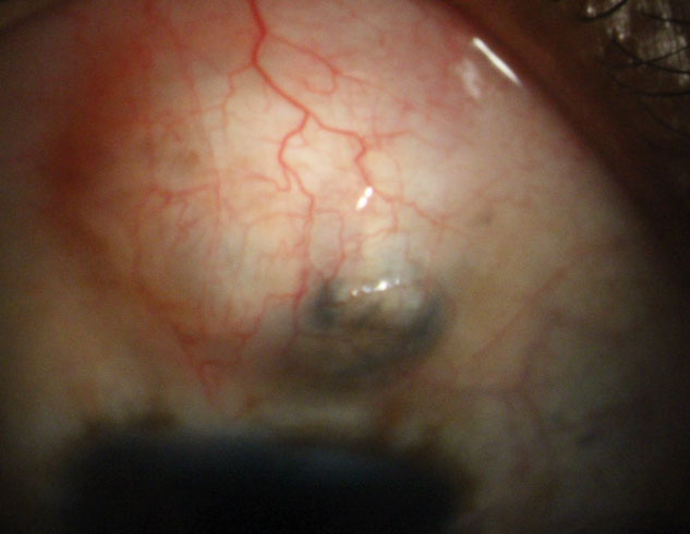 In this study, the frequency of postoperative trabeculectomy complications did not differ between the groups with and without BCVA decline.