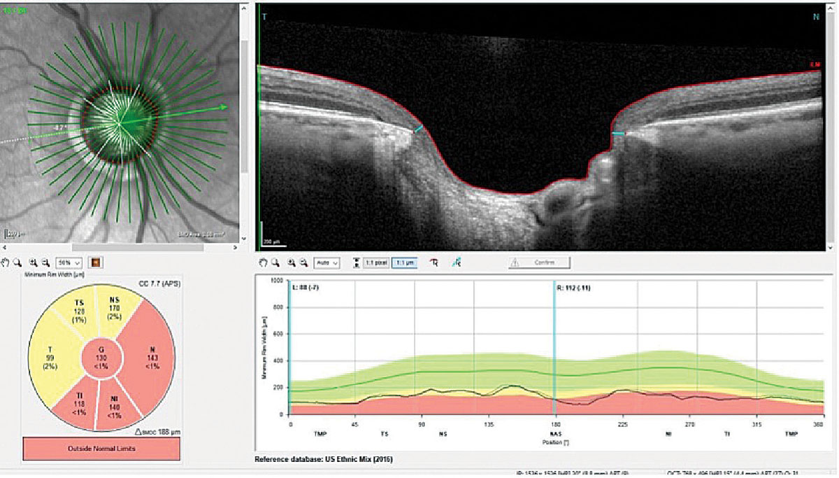 Low blood pressure may also be a risk factor for glaucoma. Experts caution against overtreatment of hypertension.