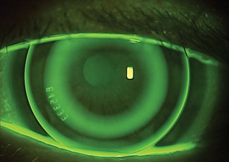 When offering orthokeratology, opt for a 5mm back optic surface design in low myopes but a larger diameter for refractions above -2.5D.