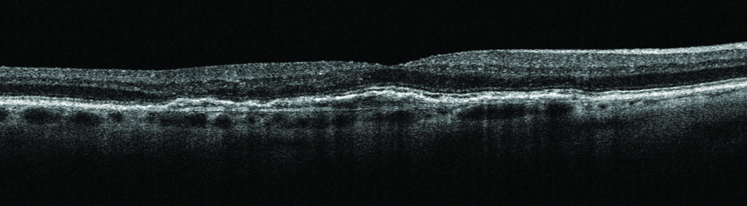 Double-Layer Sign Portends Fourfold Higher Risk of Exudative Macular ...