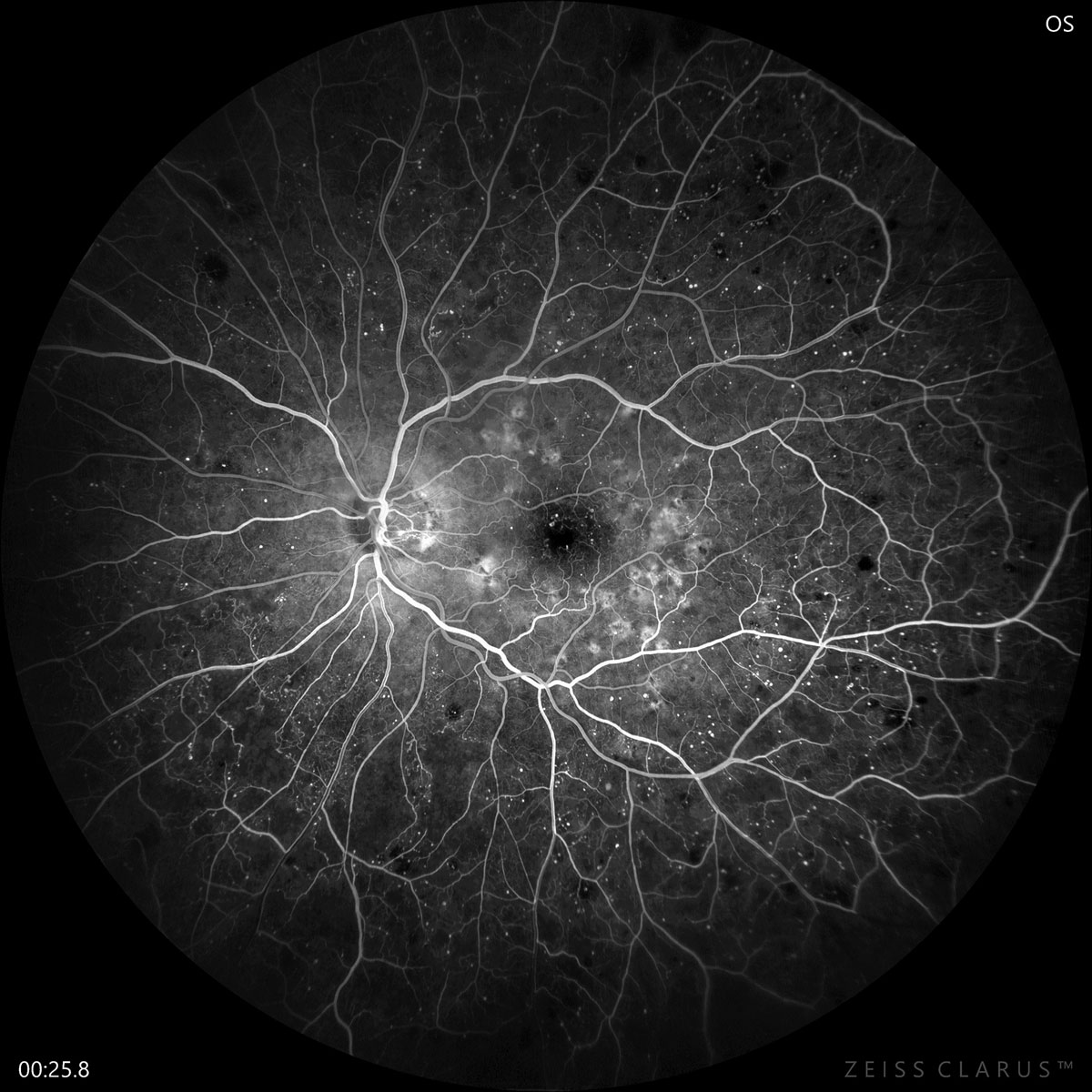 This UK-based study found that biennial screening for patients with diabetes (as opposed to annual screening) would have delayed diagnosis by one year for 56.3% of individuals with sight-threatening DR and 43.6% with PDR.