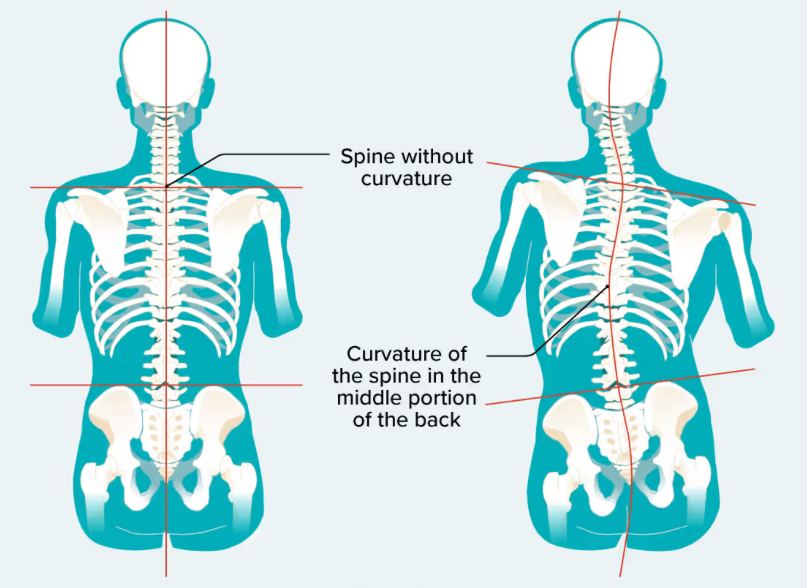 Eye abnormalities leading to ocular torticollis weaken over time through compensatory body posture, resulting in scoliosis, which can cause doctors to ignore problems with ocular muscles, the researchers argued in their paper.