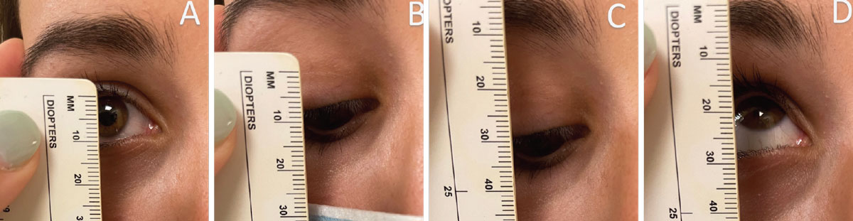 Fig. 1. Image A represents measuring palpebral aperture. In this instance, the palpebral aperture is 10mm. Image B represents measuring lid crease; there may be more than one lid crease present and all should be measured. The lid crease here is 7mm. Images C and D represent measuring levator function. Levator function is measured by the difference between down and up gazes. Here, the levator function is 14mm.