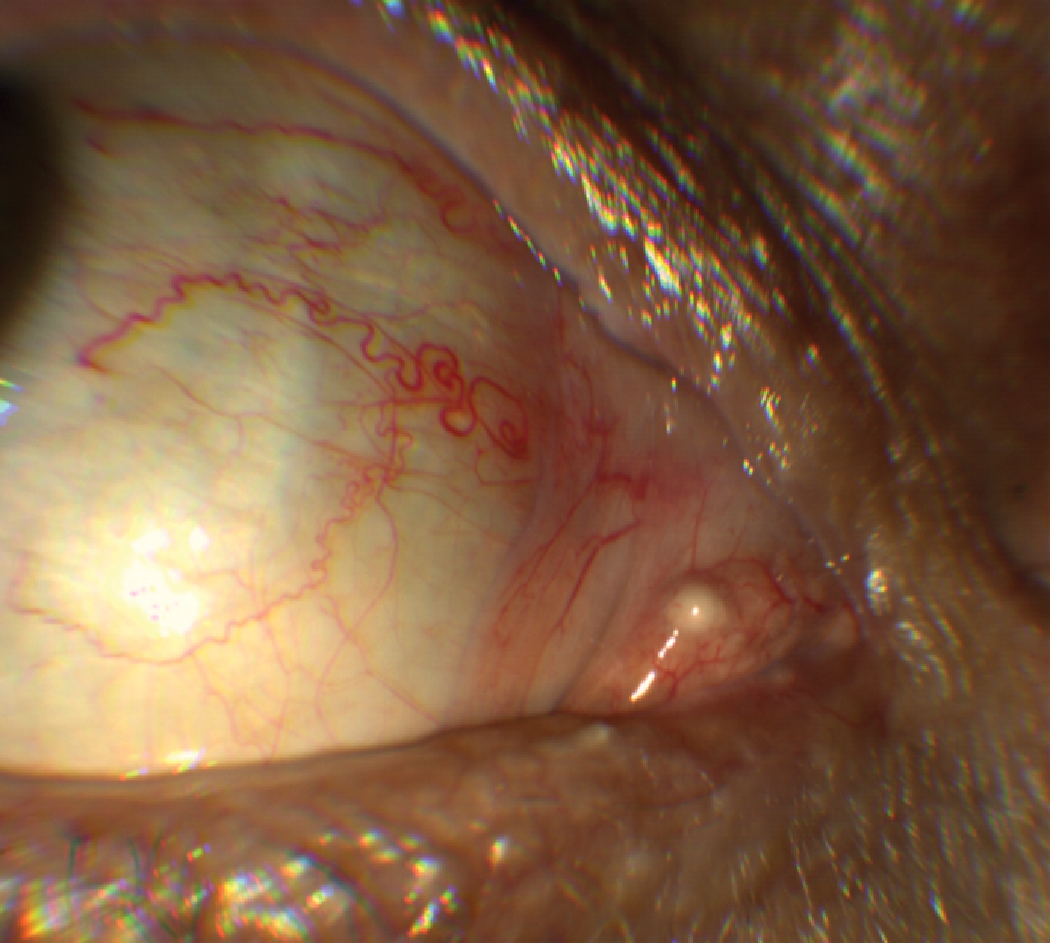 A case of a sebaceous cyst on the right caruncle of this 67-year-old Caucasian male. Although rare, they may occasionally occur on the inner canthus including the caruncle and within thin (vellus) eyebrow hairs over the periocular skin.2