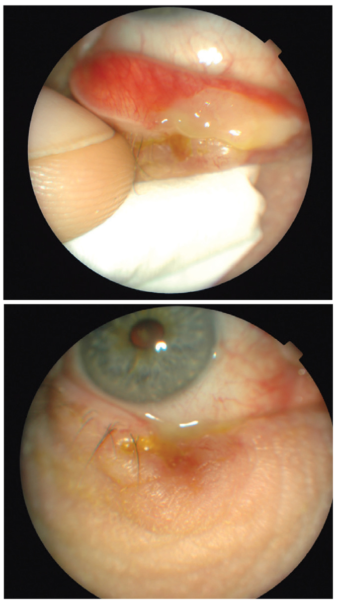 Case 1, recurrent hordeolum removal.