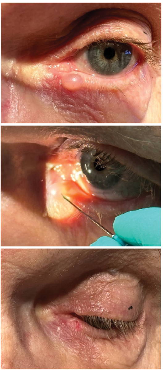 Case 3, eccrine cyst drainage.