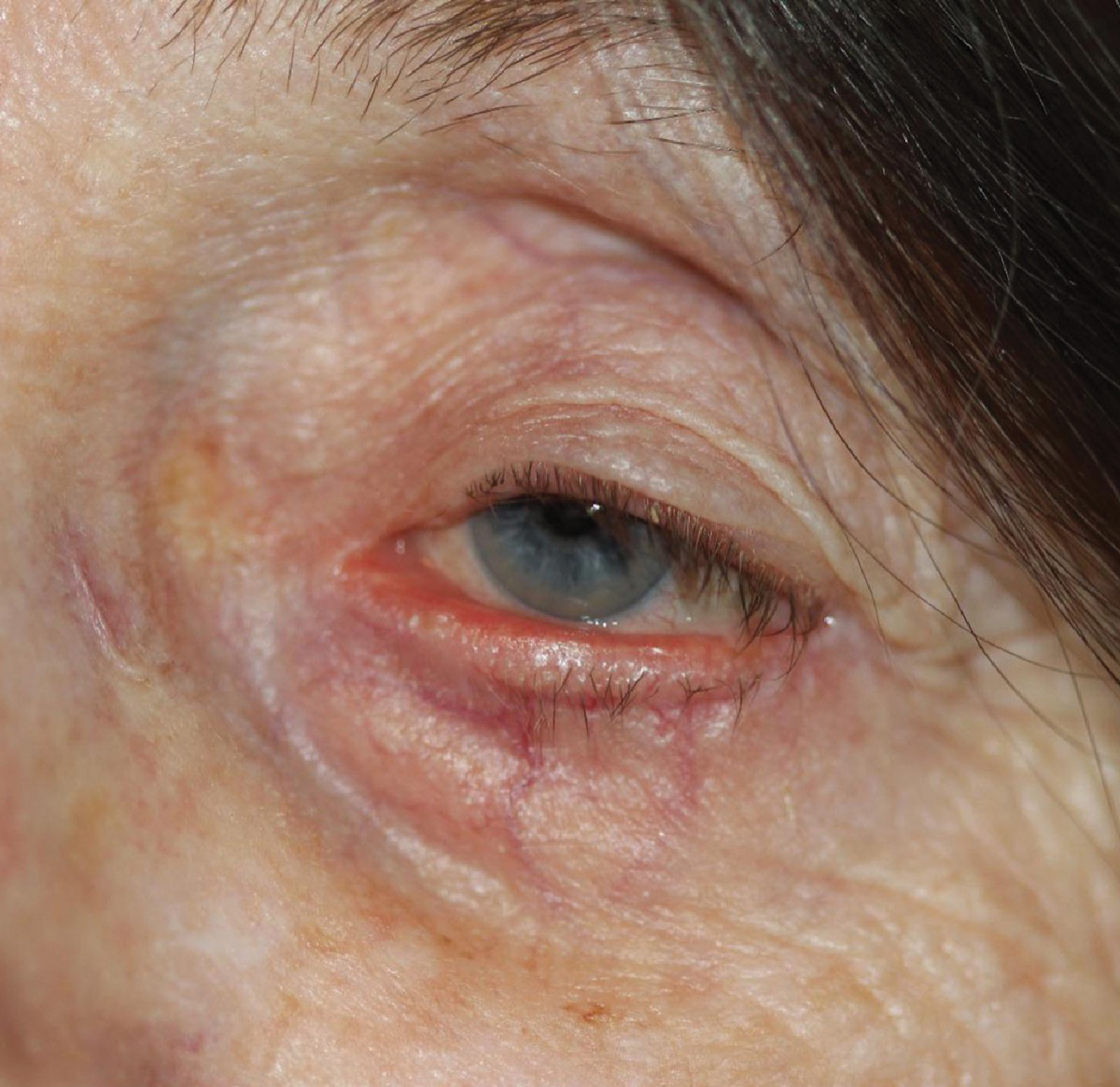Lesson: A Game Plan for Managing Eyelid Lesions and Related Conditions