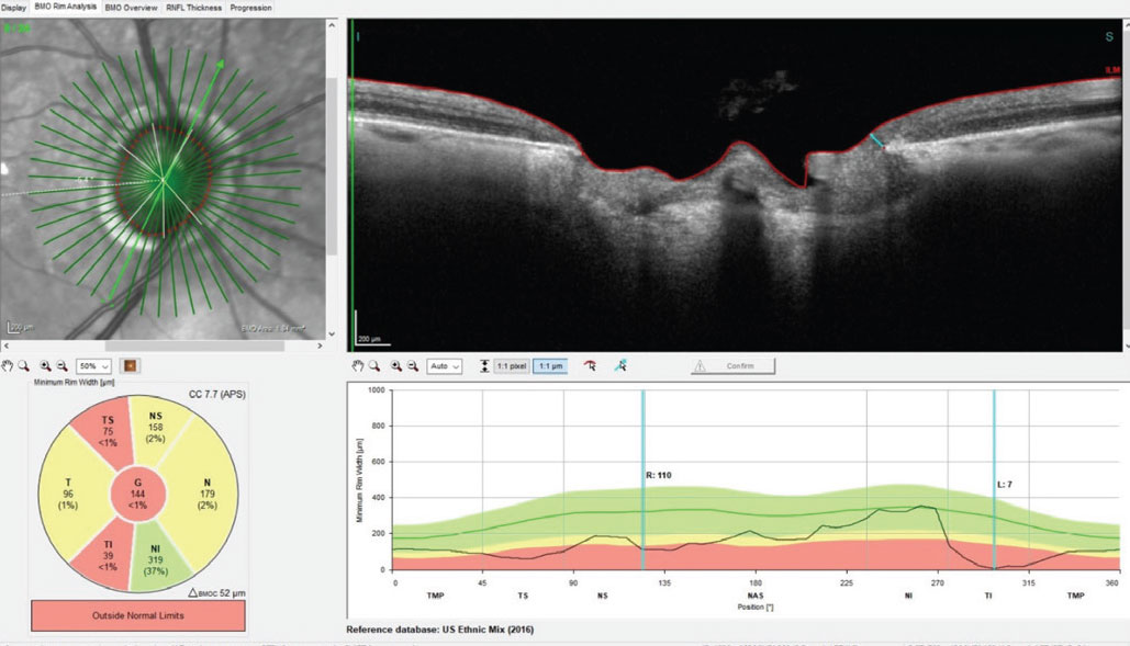 Fig. 1. A Bruch’s membrane opening-minimum rim width (BMO-MRW) scan of the right optic nerve. Note in the section provided, erosion of the inferotemporal neuroretinal rim at the seven o’clock position to a paltry 7µm of remaining axons.