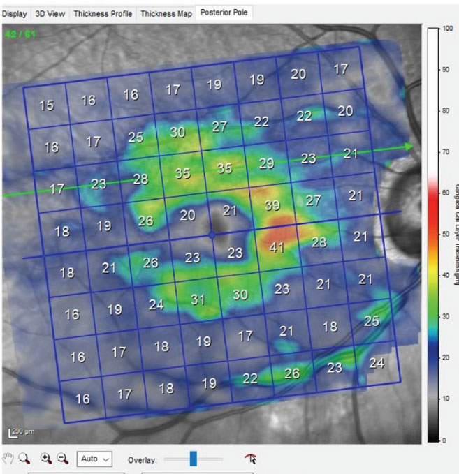 Fig. 2. Ganglion cell layer scan of the patient’s right macula, showing significant loss of ganglion cells in the inferior right portion, which is consistent with inferotemporal neuroretinal rim thinning.