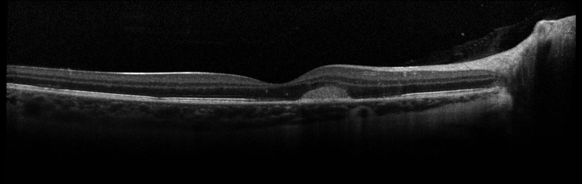 Fig. 3. Spectralis Heidelberg OCT of the right eye.