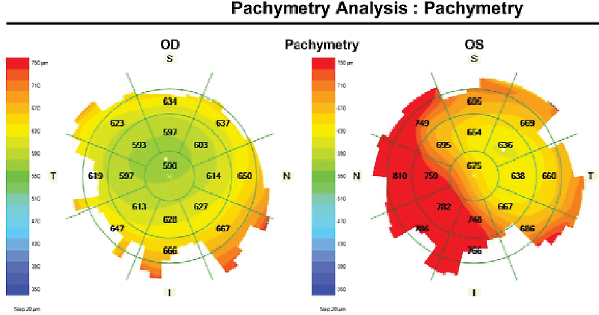 Increased corneal thickness in the left eye with corneal decompensation.