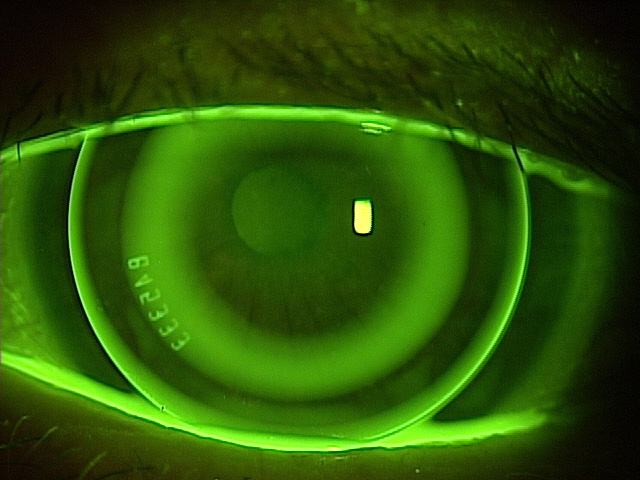 The meta-analysis demonstrated that the lens option significantly reduced the diopter change, the length of ocular axis and the amount of ocular axis change over both one and two years.