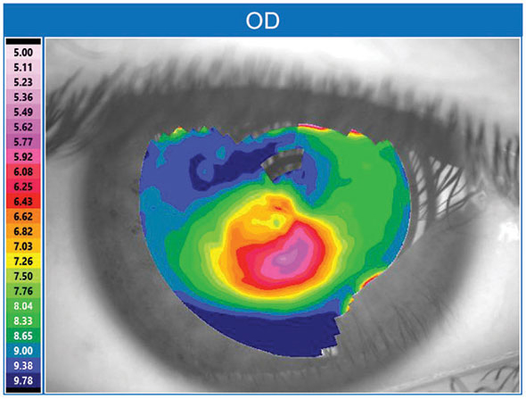 Diagnosis is often delayed in Black female keratoconus patients in particular.