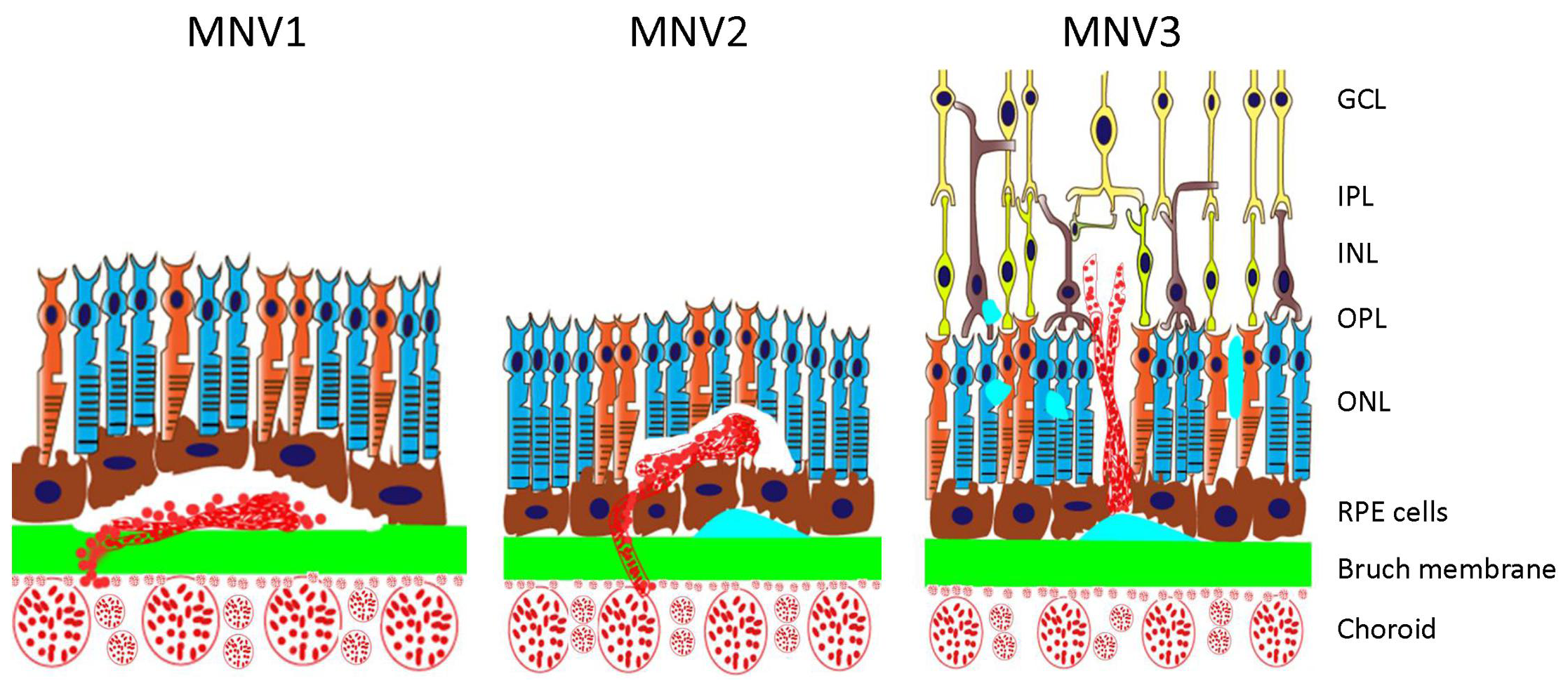 This study found that MNV lesion types may predict response to anti-VEGF treatment.