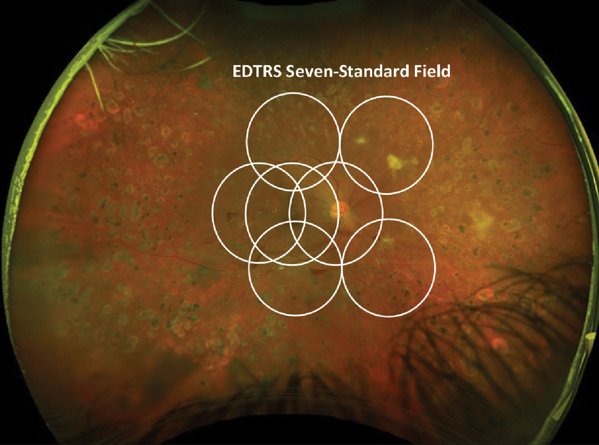 Although all imaging systems performed well in this study, the authors caution that shifting from one platform to another could change the patient’s score on the Diabetic Retinopathy Severity Scale.