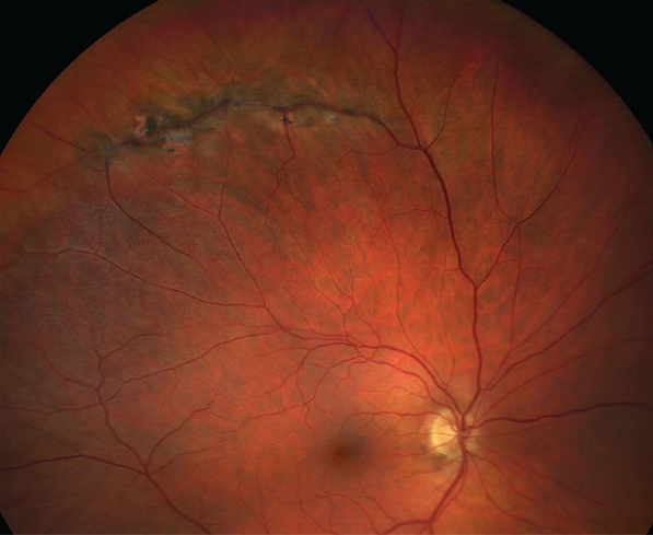 Eyes with peripheral vitreoretinal abnormality and strong vitreoretinal adhesion at the time of full-PVD development will progress into RRD. In contrast, the eyes with peripheral vitreoretinal abnormality of which significant vitreoretinal adhesion had been released would stay attached even after full-PVD development.