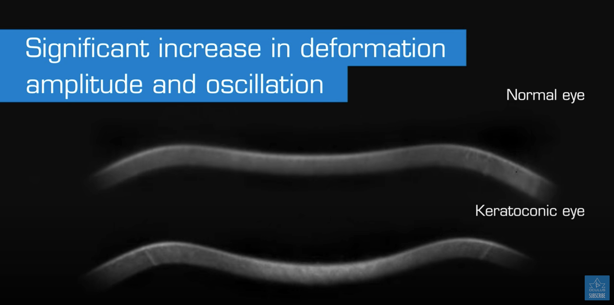 Video analysis of dynamic Scheimpflug tonometry data was used in this study to measure mean corneal stiffness, which researchers found differed significantly between patients with clinically manifested keratoconus and controls.