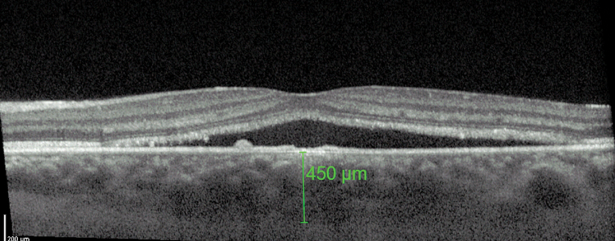 The occurrence of ellipsoid zone rupture in this elderly cohort will inevitably affect the physiological and metabolic activities of photoreceptors, and may also affect RPE cells, which will eventually reduce their pumping capacity and lead to the decline of vision.