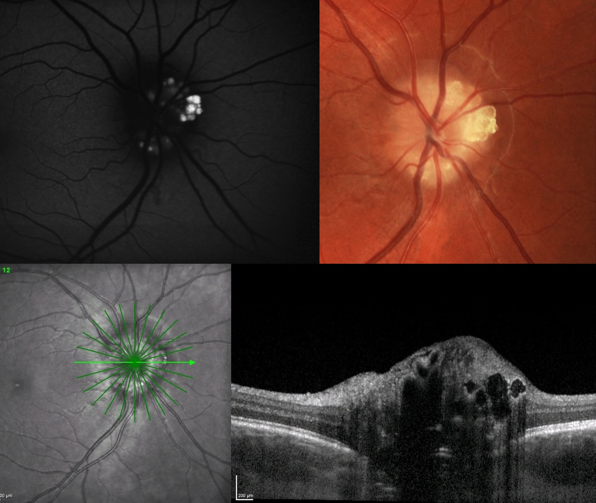 Future studies should strive to employ EDI-OCT to obtain a full phenotype involved in combined ODD and RP. 