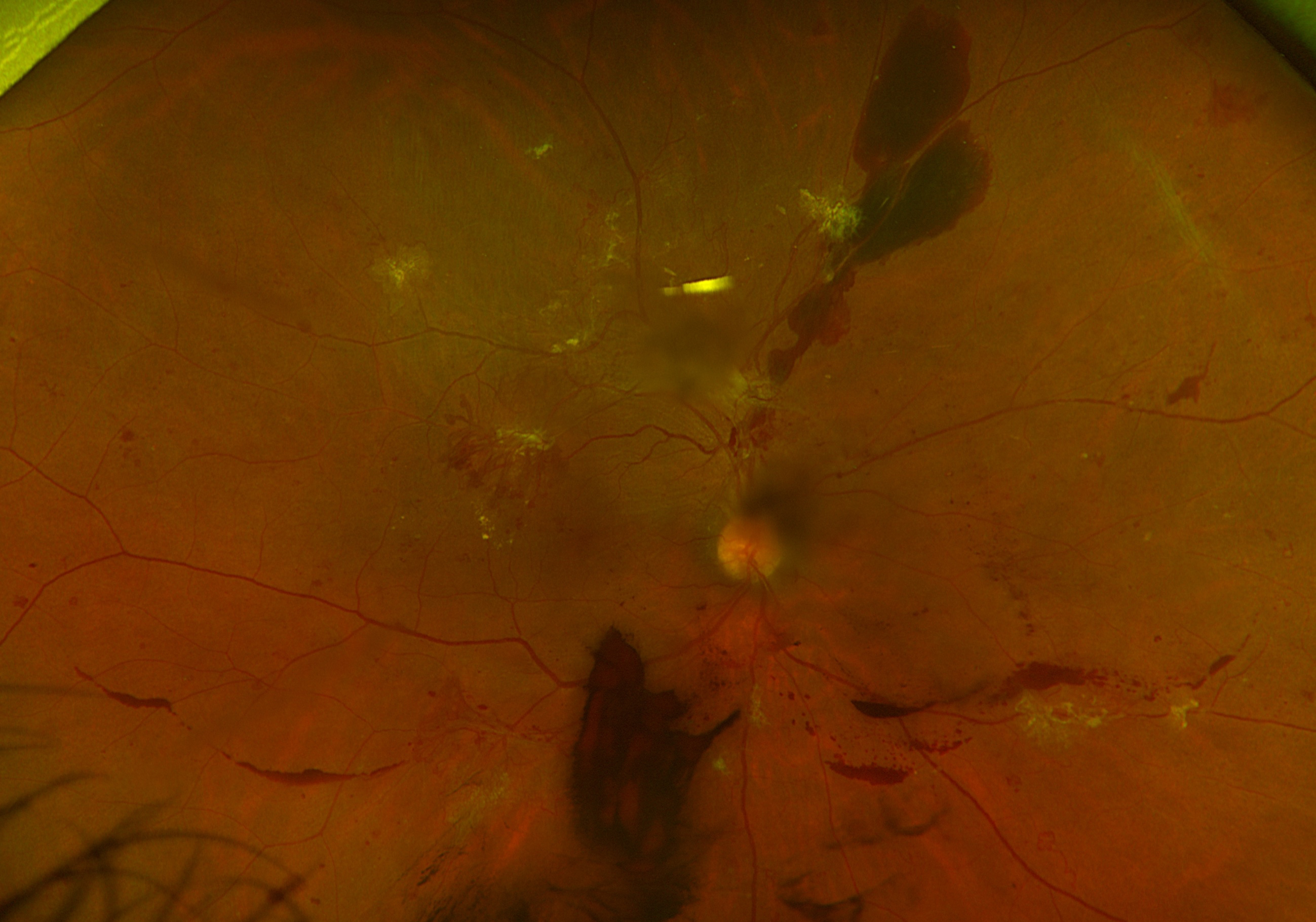 To more accurately explore the relationship between DR and different refractive degrees in different races of a Western population, researchers analyzed the data from the National Health and Nutrition Examination Survey dataset.