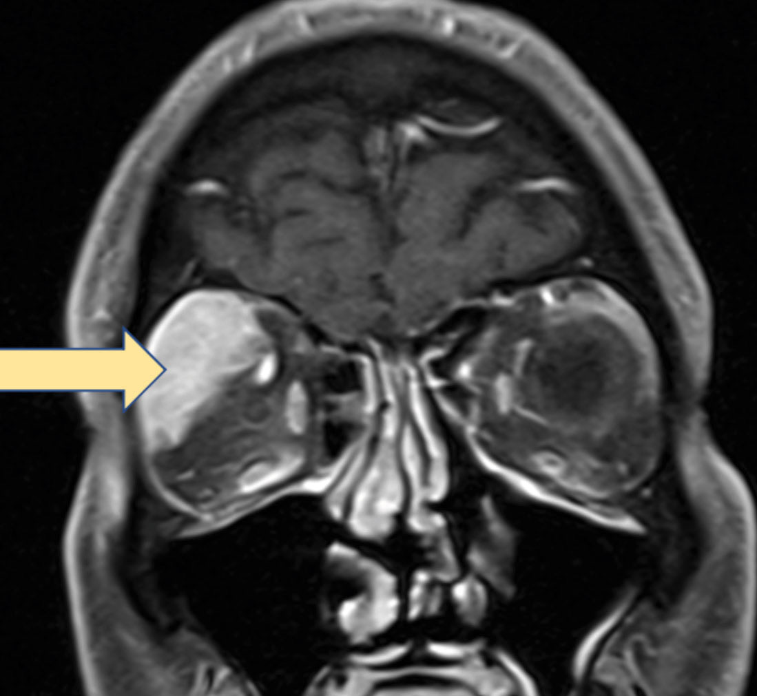 Researchers say that the sluggish improvement in survival rates of lacrimal gland malignancies over the years points to an alarming need for improved diagnostics and therapeutics. 