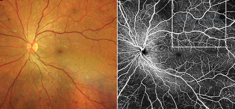 Sex-based alterations appear to exist in diabetic microvascular disease, which should be considered in future clinical studies on DR and its OCT-A biomarkers. 