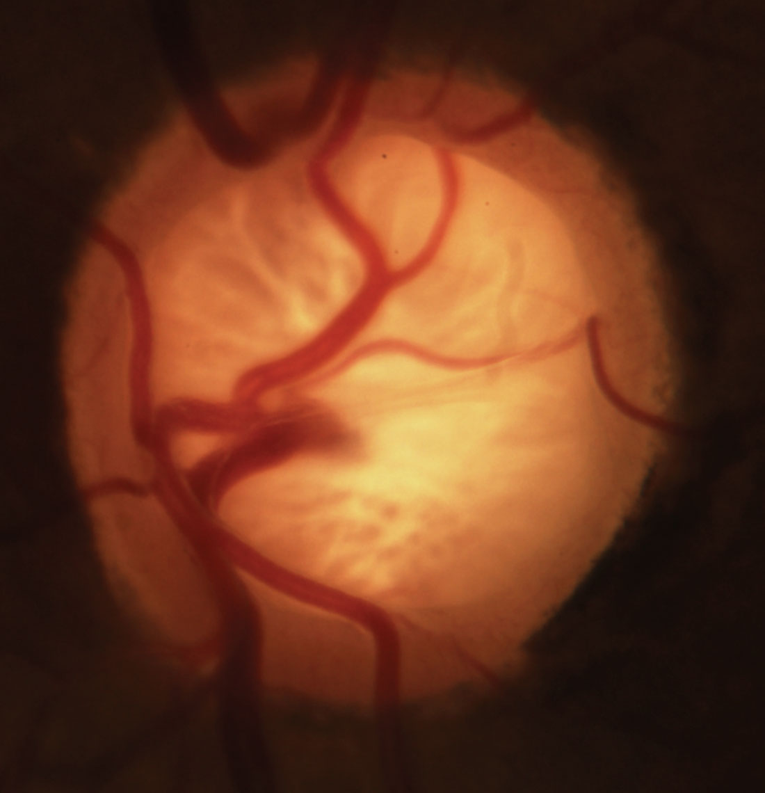 Blood pressure dip in POAG may not be restricted to the well-established nocturnal phenomenon, as the patients in this study also experienced exaggerated dips when going from a seated to a supine position. 