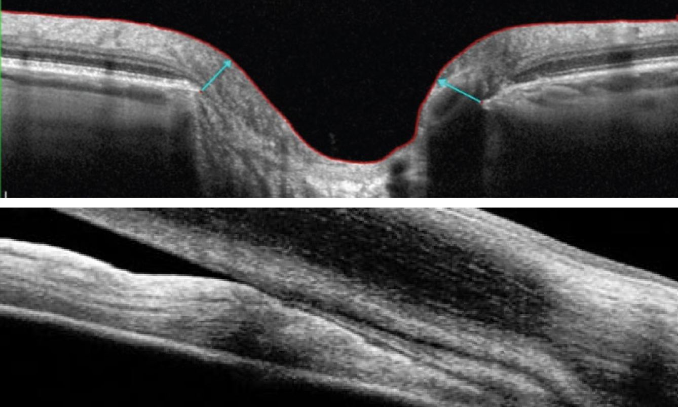 Inferior field loss in PACG patients was found to have a total deviation difference of up to 3.2 dB worse than POAG patients at the same degree of RNFL loss. Researchers did not present information to confirm the mechanism of inferior field loss, but they encourage clinicians to not dismiss this as an artifact in the presence of preserved RNFL on OCT in a patient with PACG.