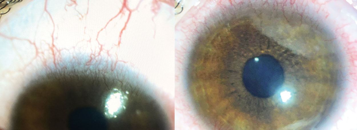 Fig. 1. Contact lens peripheral ulcer (CLPU) in the setting of contact lens over wear.