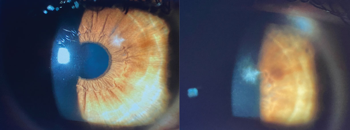 Fig. 3. Small, discrete, focal stromal infiltrate masquerading as sterile infiltrate given minimal concomitant signs and symptoms; however, culture positive for yeast. Central location and feathery margins are often seen in fungal ulcers.