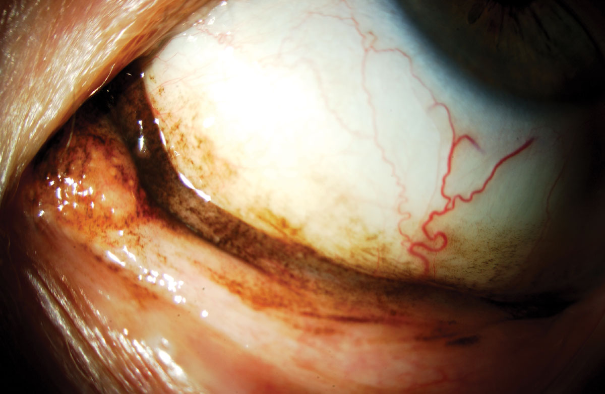 Fig. 3. Malignant melanoma of the conjunctiva.