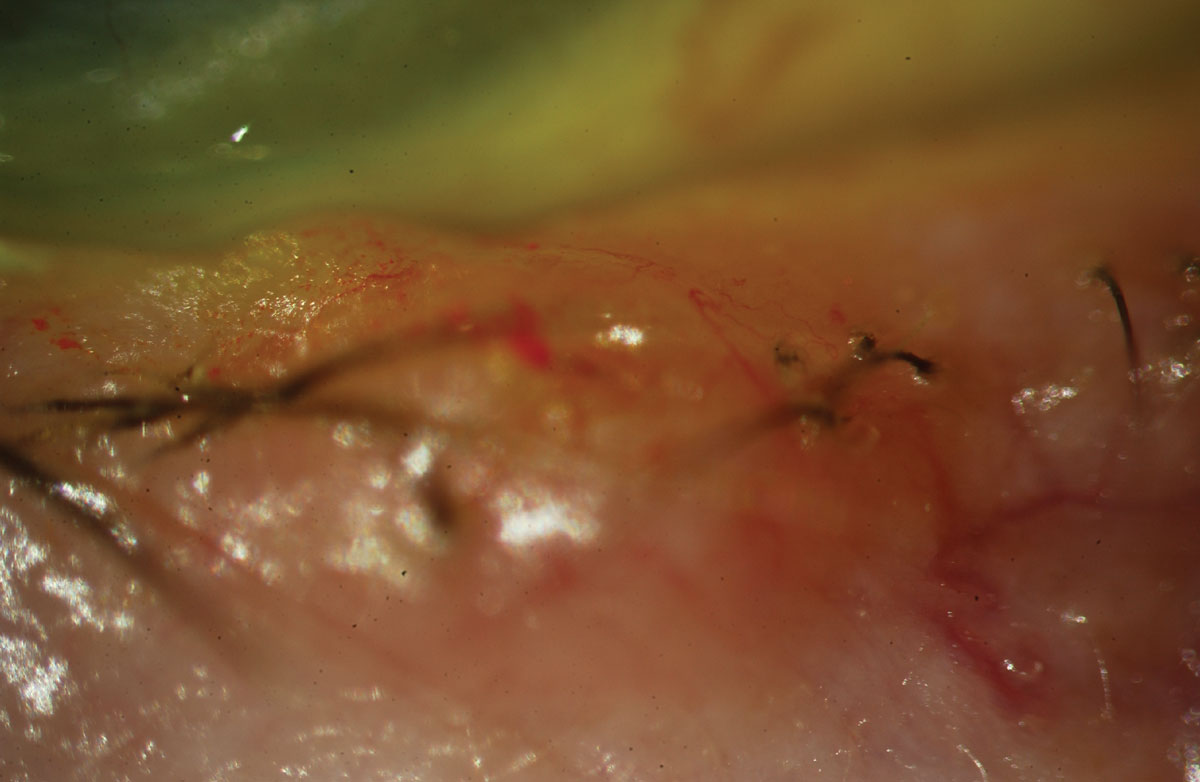 Fig. 2. Basal cell carcinoma with pearly margins and madarosis.