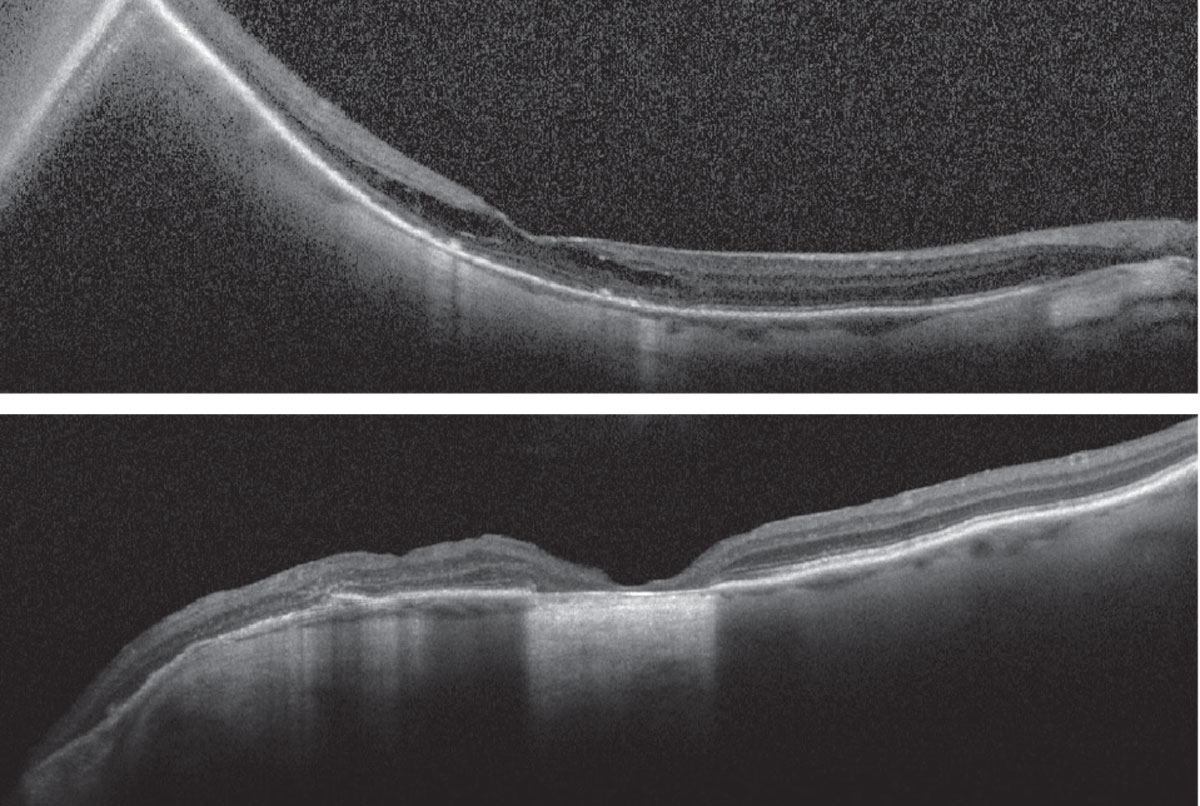 Figs. 3 and 4. Heidelberg Spectralis OCT of the right eye (top) and left eye (bottom).