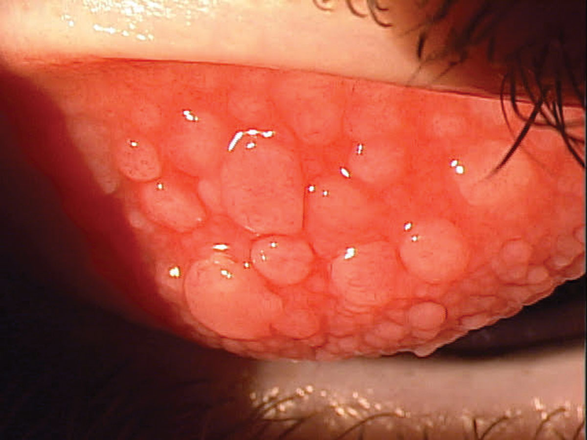 From 2008-2009 to 2018-2019, the prevalence of POSID among people of Asian descent rose from 6.26 to 11.80 cases per 10,000 people, largely due to an increase in cases of vernal keratoconjunctivitis. 