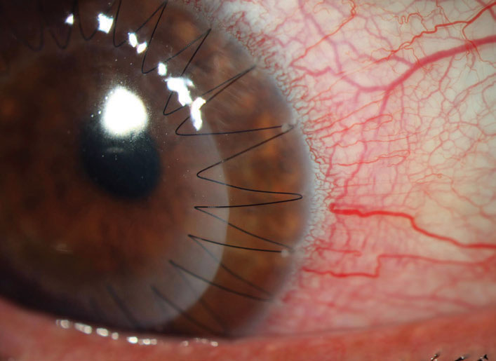 Onset of late ectasia is usually decades following PK.