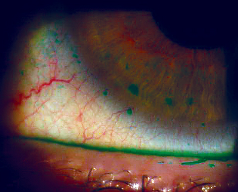 Worsening of dry eye symptoms was associated with increased screen time, corroborating previous findings suggesting that screen time can lead to increases in dry and uncomfortable eyes.