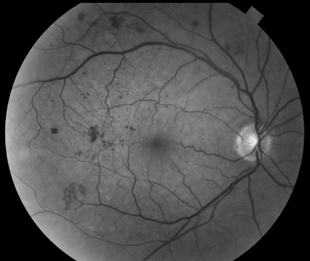 Despite their likely supportive role in treating dry eye, omega-3 fatty acid supplements have yet to show evidence of an effective in diabetic retinopathy.