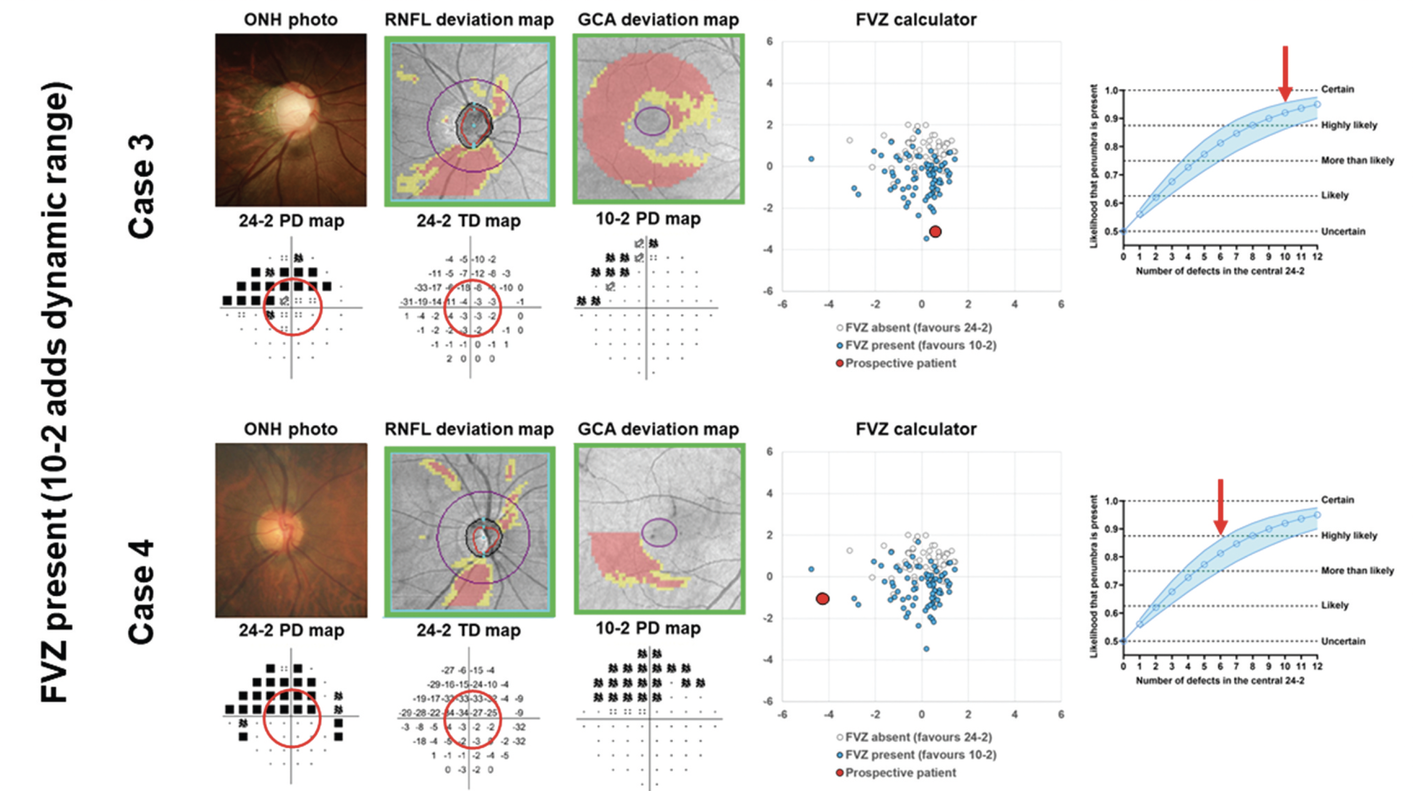 The FVZ in VF testing reflects a potential zone where residual VF sensitivity or test dynamic range, if captured, allows for ongoing monitoring of the glaucomatous VF defect. In these examples, an FVZ is likely to be present (red dots and red arrows). 